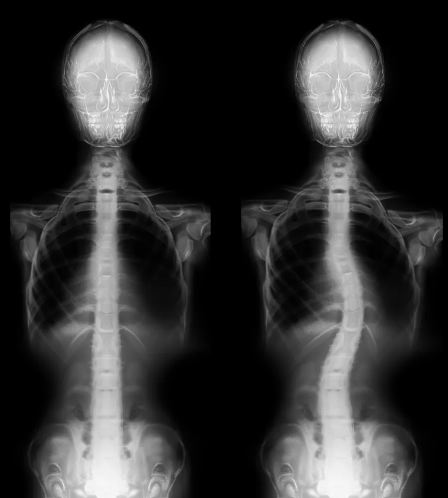chiropractic care for scoliosis Green Bay